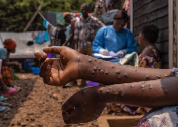 Alerte Mpox au Sénégal : un deuxième cas confirmé