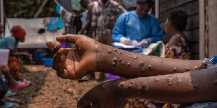 Alerte Mpox au Sénégal : un deuxième cas confirmé