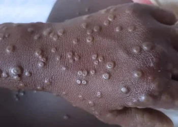 Sénégal : Deux nouveaux cas de Mpox confirmés