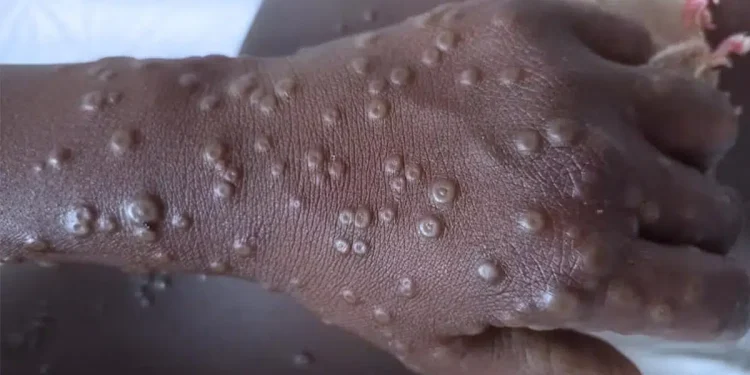 Sénégal : Deux nouveaux cas de Mpox confirmés
