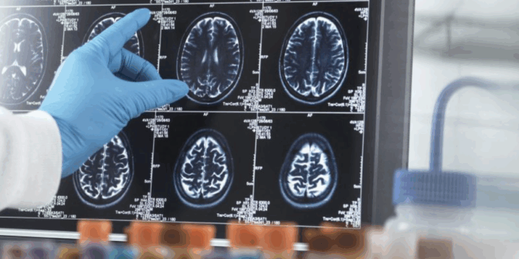 11 millions de morts chaque année : l’OMS alerte sur les maladies neurologiques